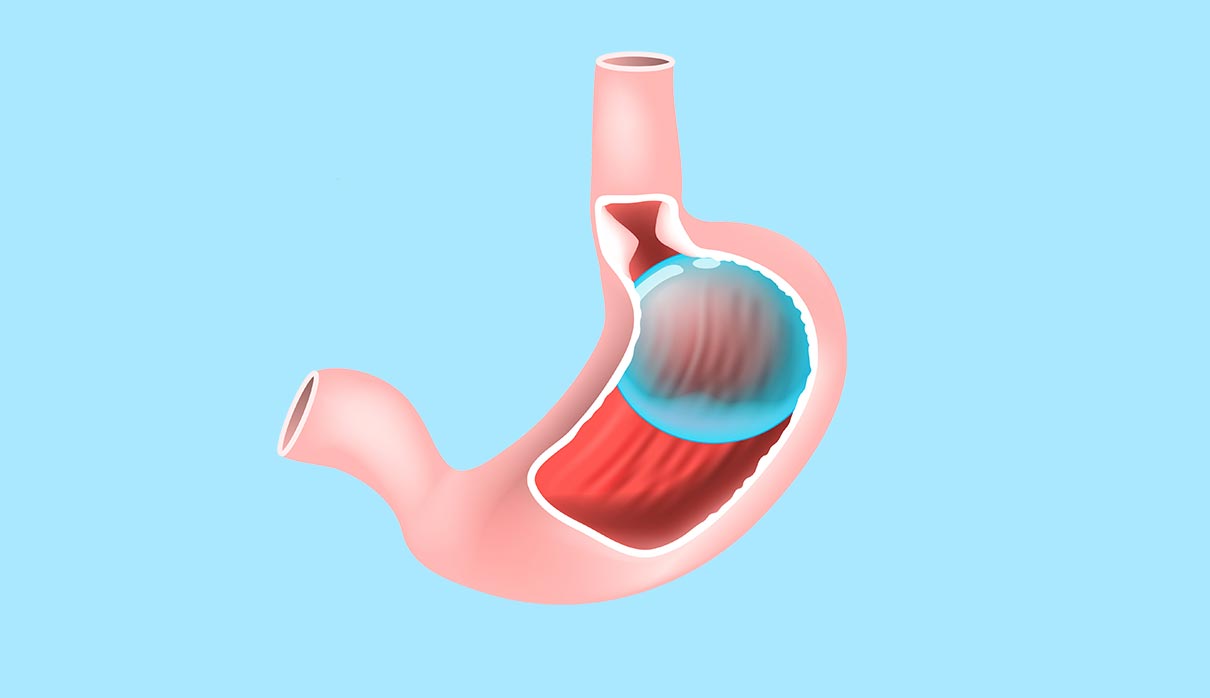Obesity Treatment Methods